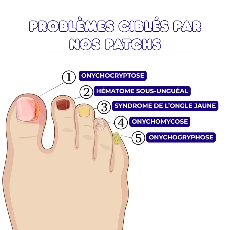 32x Patchs de Traitement Anti-Mycose pour Pieds
