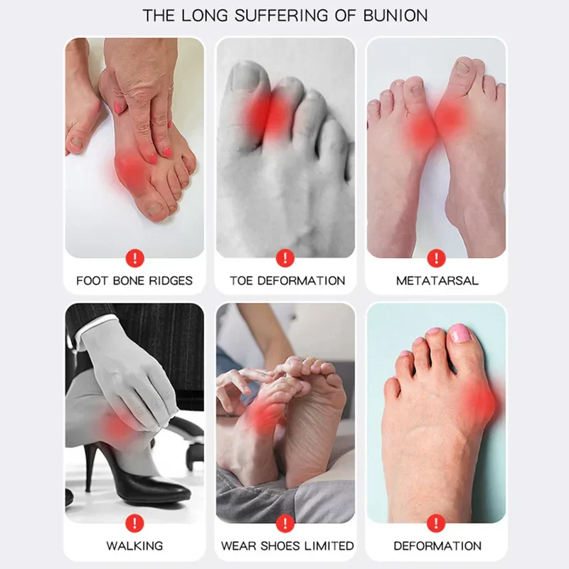 Orthèse Ajustable Hallux Valgus Anti-Douleur